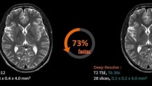 西门子医疗利用人工智能加速磁共振扫描时间、提高成像质量