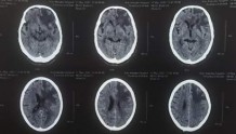 脑脓肿能治好吗？