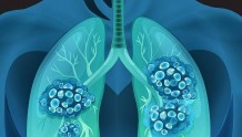 87%的肺癌病例可归因于烟草暴露，长期被动吸烟也要小心肺癌